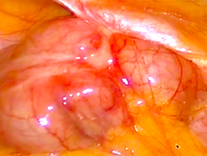 Inserting the 10mm trocar; diagnostic laparoscopy