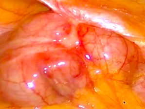 Insertion of the 10 mm trocar; diagnostic laparoscopy
