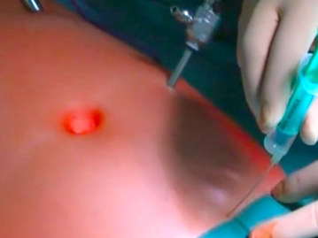 Insertion of the 5 mm Trocars; Positioning