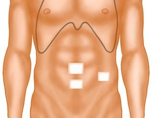 Closure of the incisions