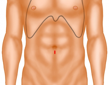 Access to the preperitoneal space