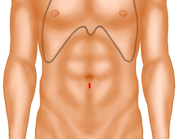 Access to the preperitoneal space