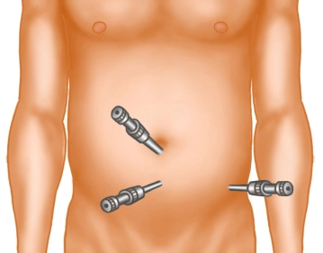 Insertion of the trocars