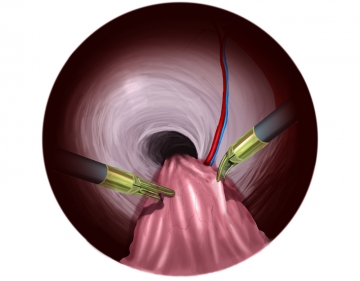 Hernia sac dissection in direct hernia