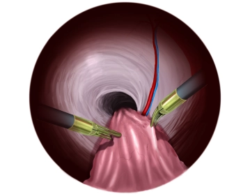 Preparation of the right side with direct hernia sac
