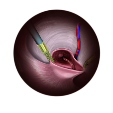 Preparation of the left side in indirect hernia sac