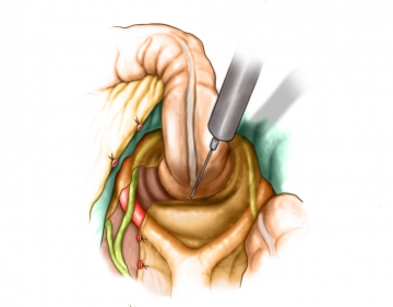 Totale mesorektale Exzision; Darstellung des li. Ureters