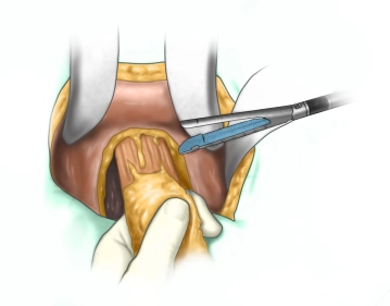 Seccionamiento del recto