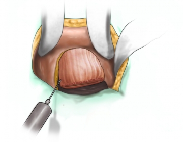 Nachresektion von Beckenperitoneum und Abszessmembranen