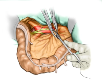 Sección central de la A. mesentérica inferior