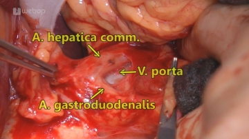 Präparation Ligamentum hepatoduodenale