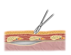 Blunt dissection