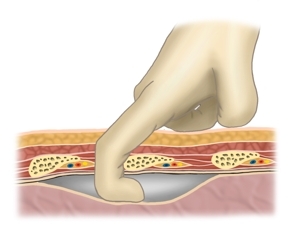 Mini-thoracotomy