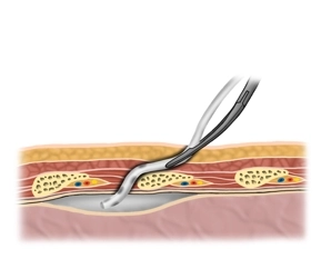 Inserting and positioning the tube