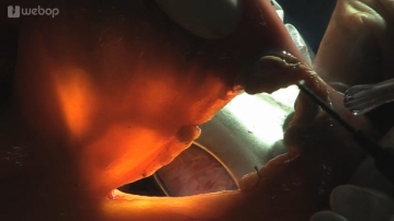 Dissecting the Roux limb