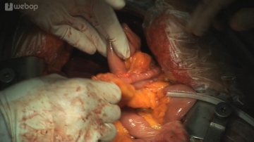 Retrocolic transposition of the Roux limb into the upper abdomen