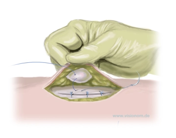 Fixation of the Navel