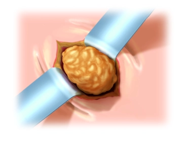 Preparation of the Hernia Sac