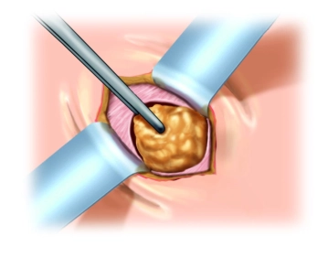 Displaying the Fascia Edges