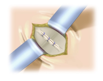 Closure of the Hernial Orifice