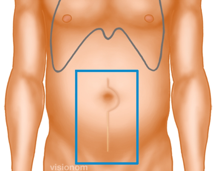 Laparoscopic Hernia Repair Ipom Following Lower Laparotomy No issues/pain prior to surgery.post op doc explained hernia was fat and repaired with mesh.surgical. laparoscopic hernia repair ipom