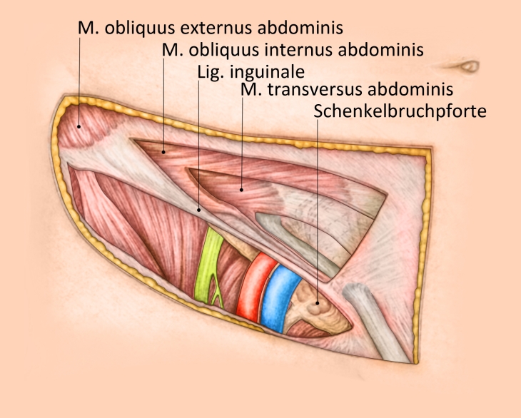 Femoral Hernia Repair Tipp Technique Webop E Learning Best Practice Surgery