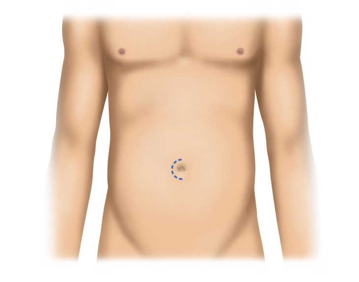 Umbilical Hernia Repair Open Preperitoneal Umbilical Mesh Plasty Pump Repair Asymptomatic hernias can be repaired. umbilical hernia repair open