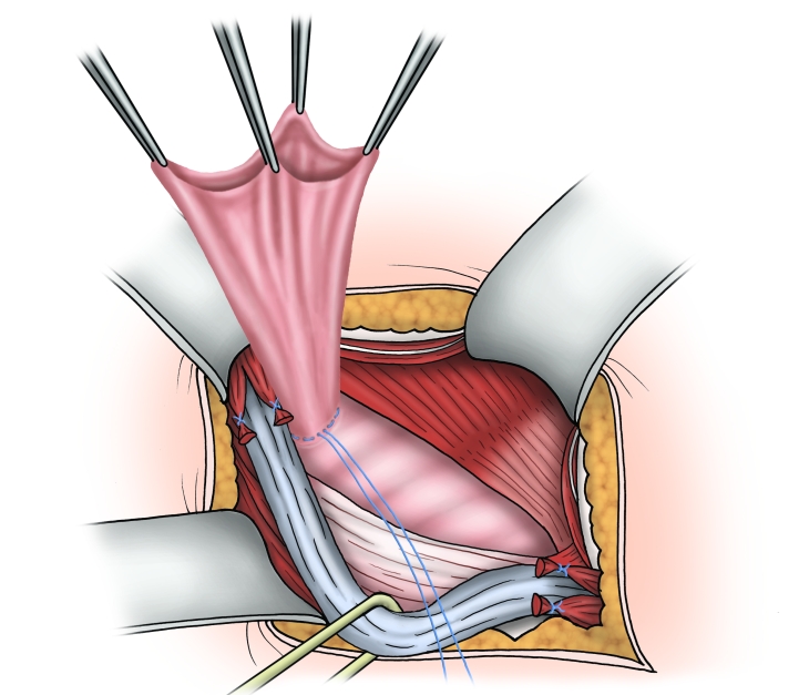 Rutkow Plug Repair In Inguinal Hernia Webop E Learning Best