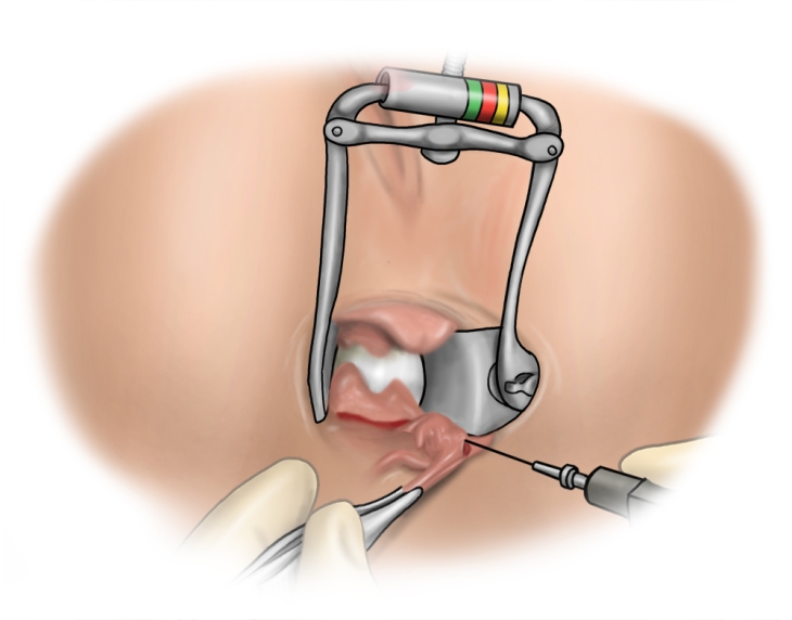 Anal Fissurectomy Webop E Learning Best Practice Surgery