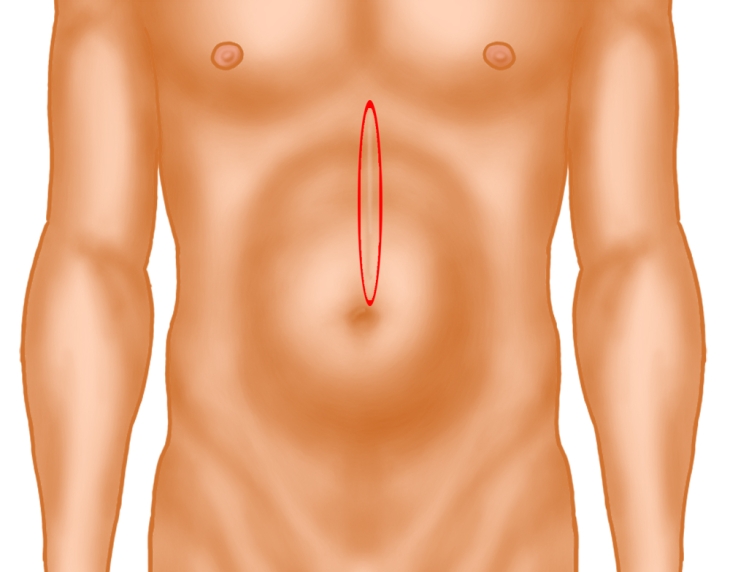 Open Incisional Hernia Repair With Retromuscular Mesh Augmentation There is a naturally occurring weakness in. open incisional hernia repair with
