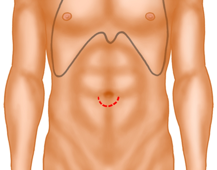 Umbilical Hernia Primary Suture Repair This includes inguinal hernia surgery recovery time, umbilical (belly button) hernia surgery recovery and femoral patients experiencing certain symptoms following hernia repair surgery should contact their doctor immediately. umbilical hernia primary suture repair