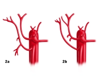 104_LAV_02_a_b_Leberarterie