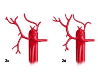 44_LAV_02_c_d_Leberarterie