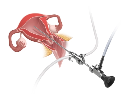 Hysteroscopy, fractional curettage Hysteroscopy, fractional curettage