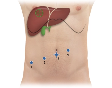 513_Trokarpositionen.jpeg 513_Trokarpositionen.jpeg