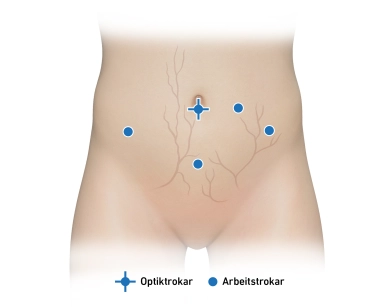 Bilateral adnexectomy, lavage cytology, laparoscopy Bilateral adnexectomy, lavage cytology, laparoscopy