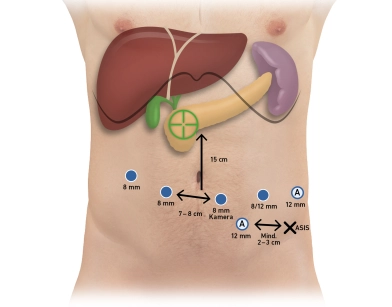 Pylorus-preserving pancreaticoduodenectomy, according to Longmire-Traverso, robotically assisted Pylorus-preserving pancreaticoduodenectomy, according to Longmire-Traverso, robotically assisted