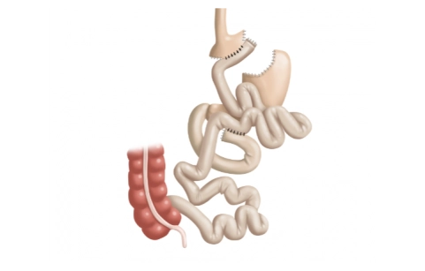 Laparoscopic gastric bypass Laparoscopic gastric bypass