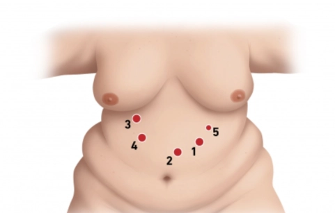 Mini gastric bypass / omega loop gastric bypass Mini gastric bypass / omega loop gastric bypass