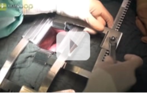 Anterolateral thoracotomy Anterolateral thoracotomy