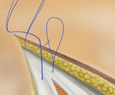 Abdominal wall closure – techniques: Loop suture and small tissue bites