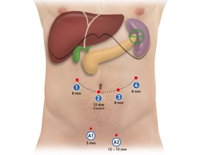 504 Trokare 504 Trokare