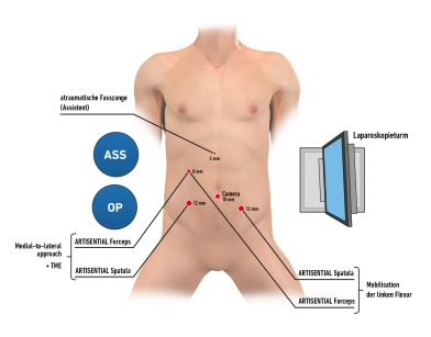 550 Setup und Trokarpositionierung 550 Setup und Trokarpositionierung